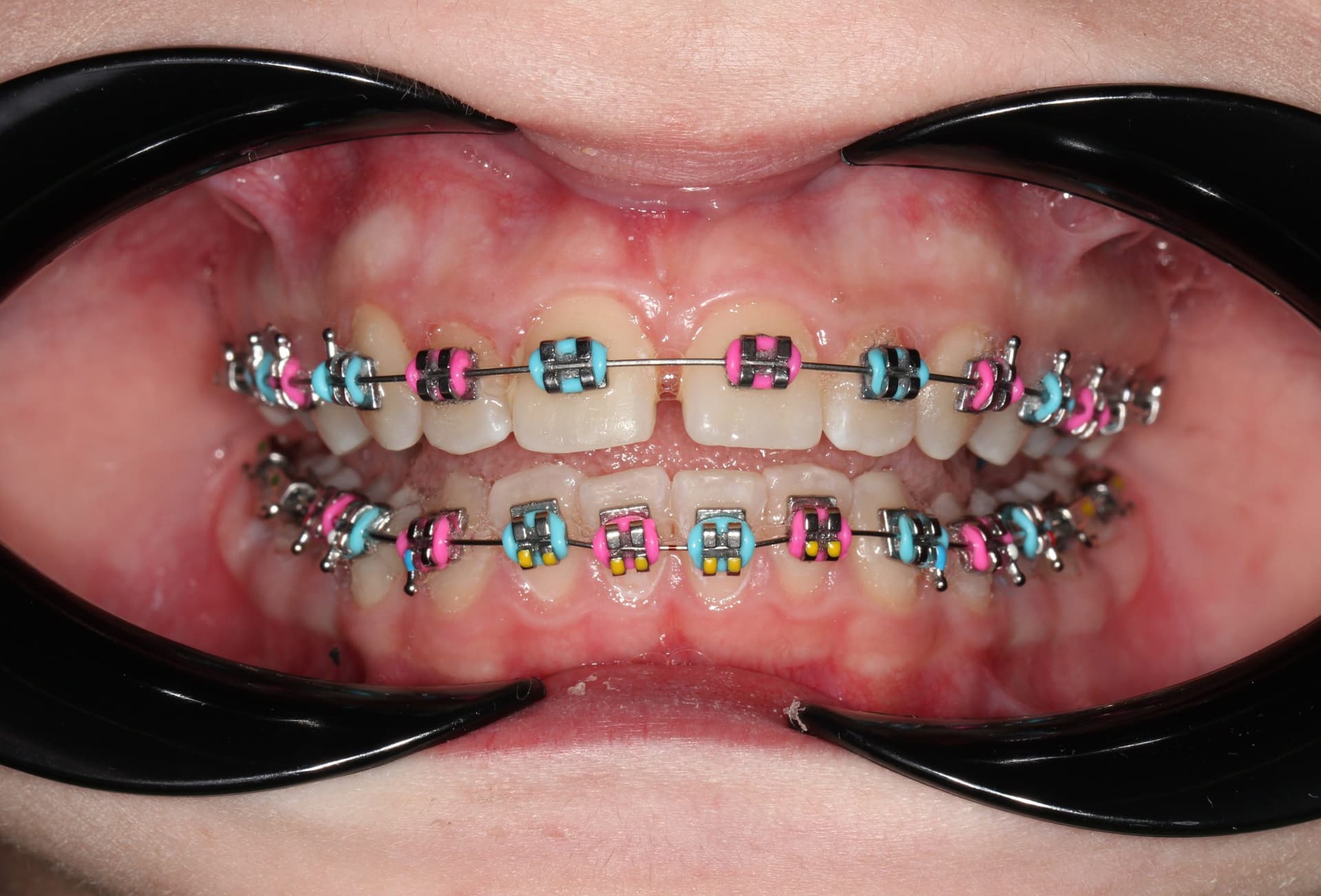 Фиксация брекет системы