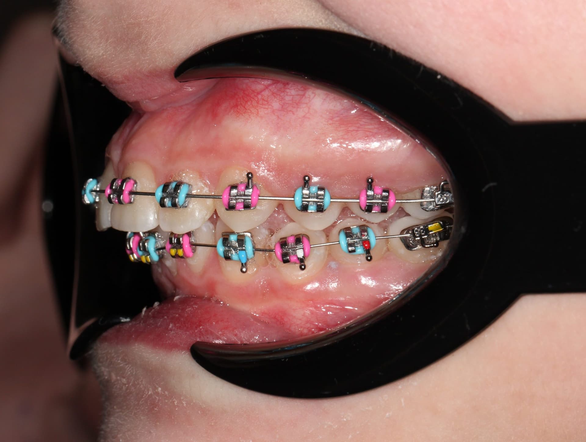 Фиксация брекет системы