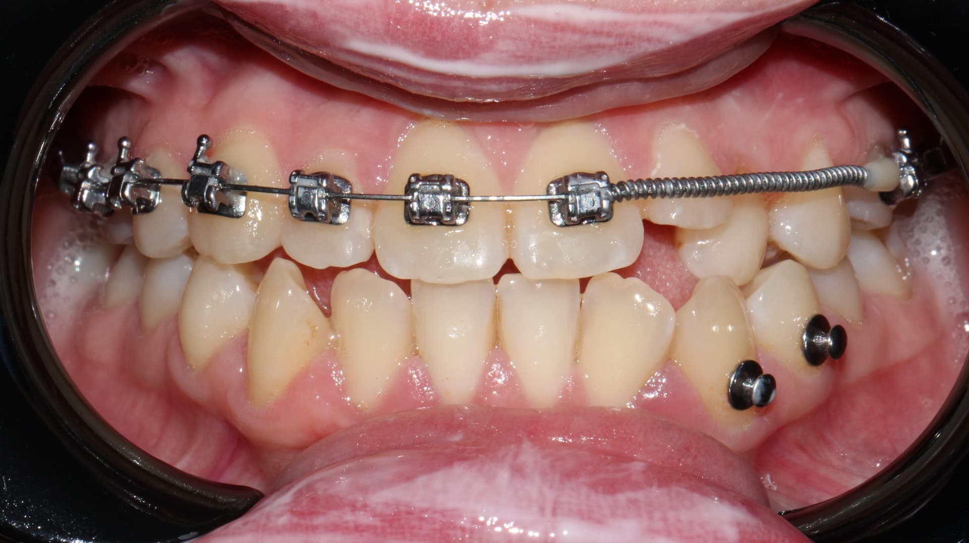 Промежуточный результат