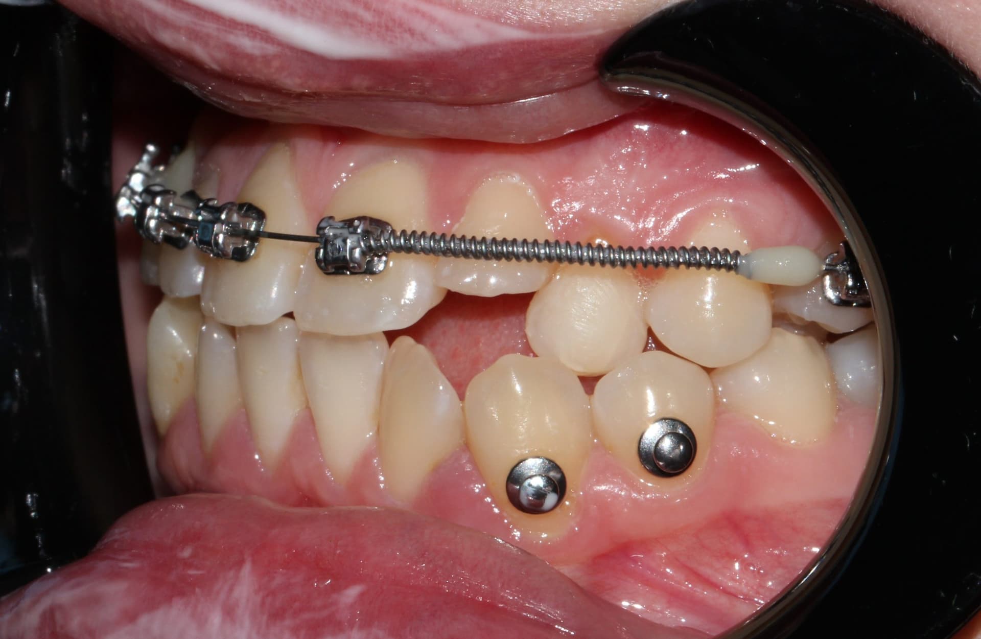 Промежуточный результат