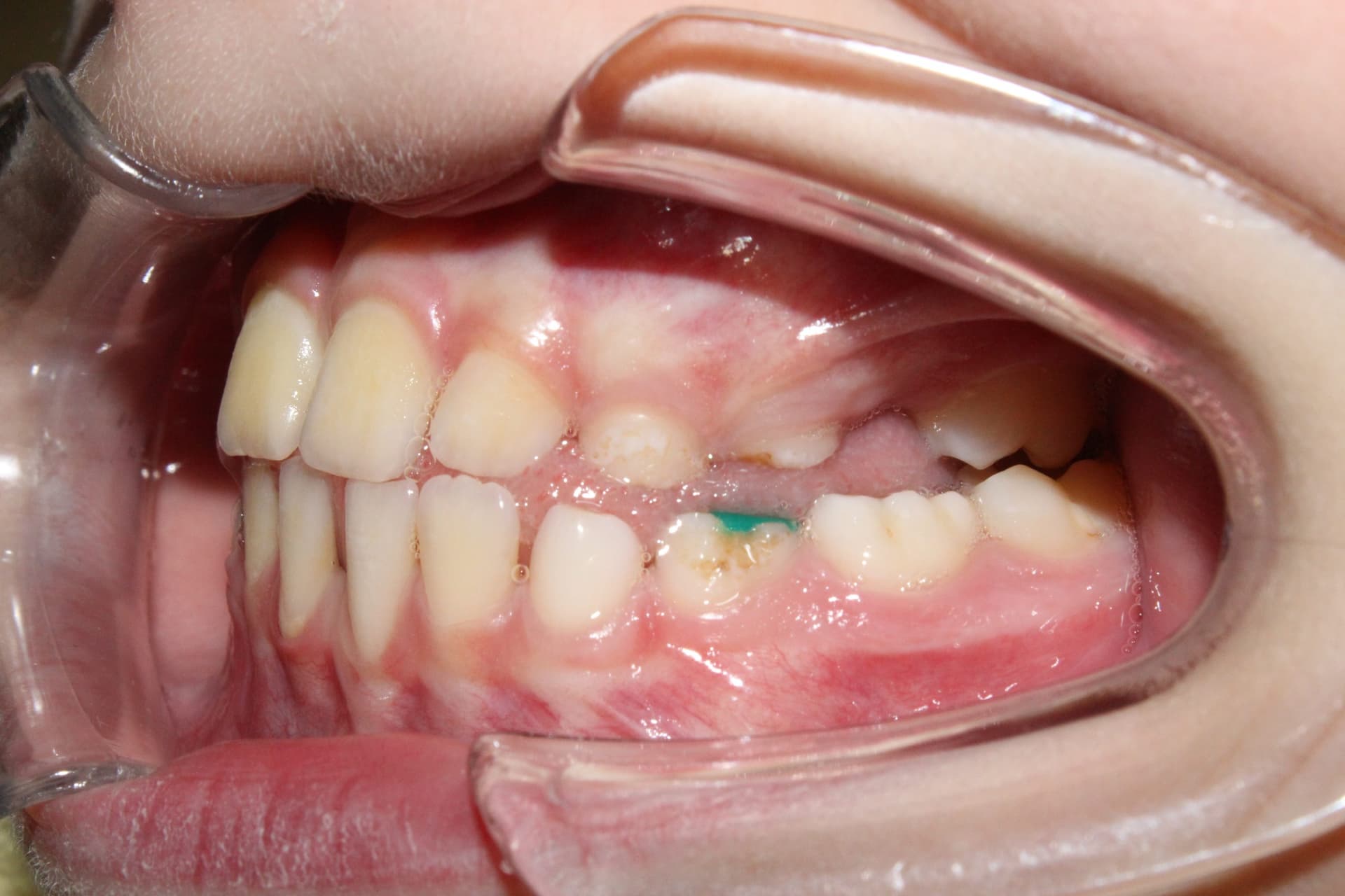 Промежуточный этап