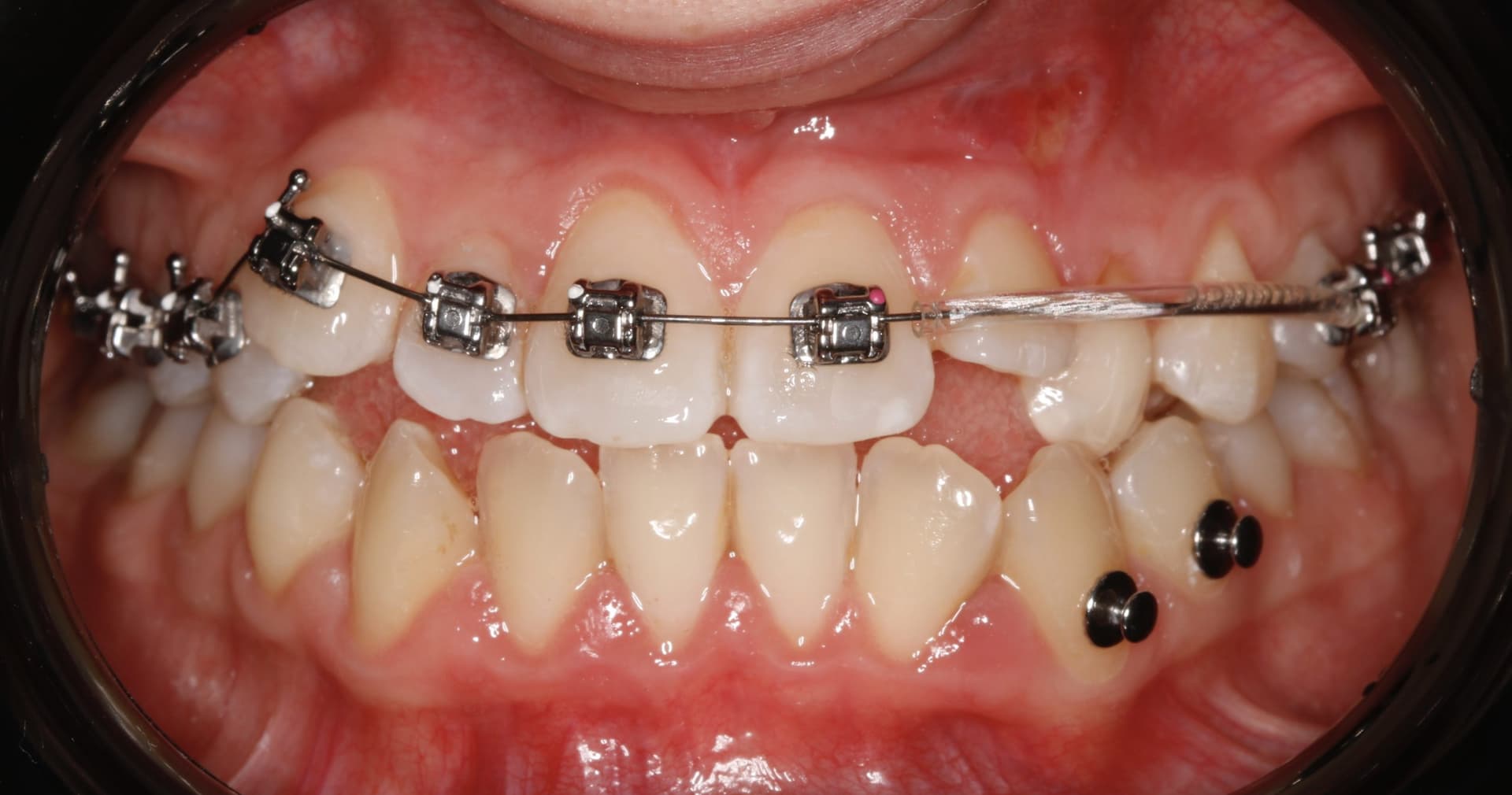 Фиксация брекет системы