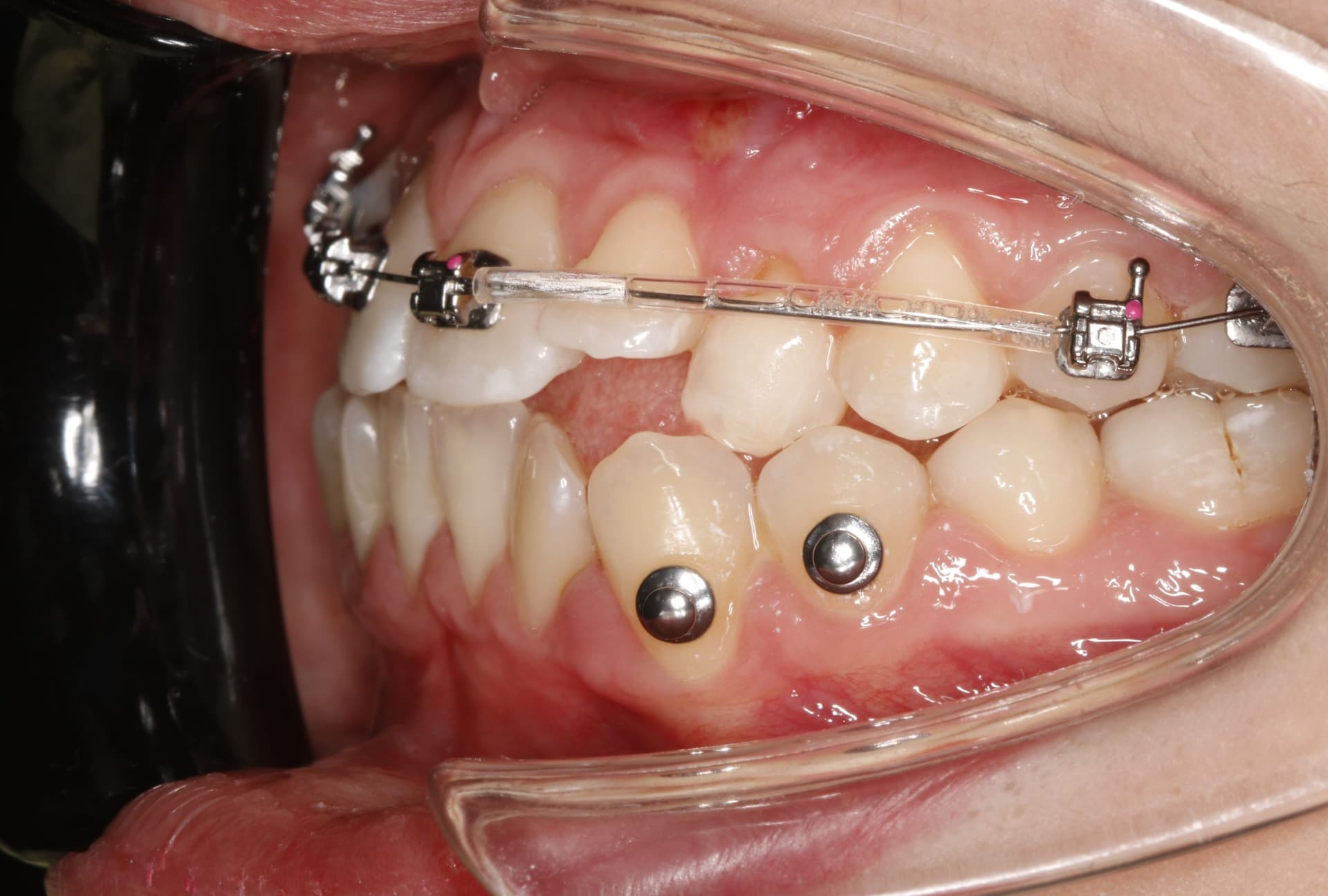 Фиксация брекет системы