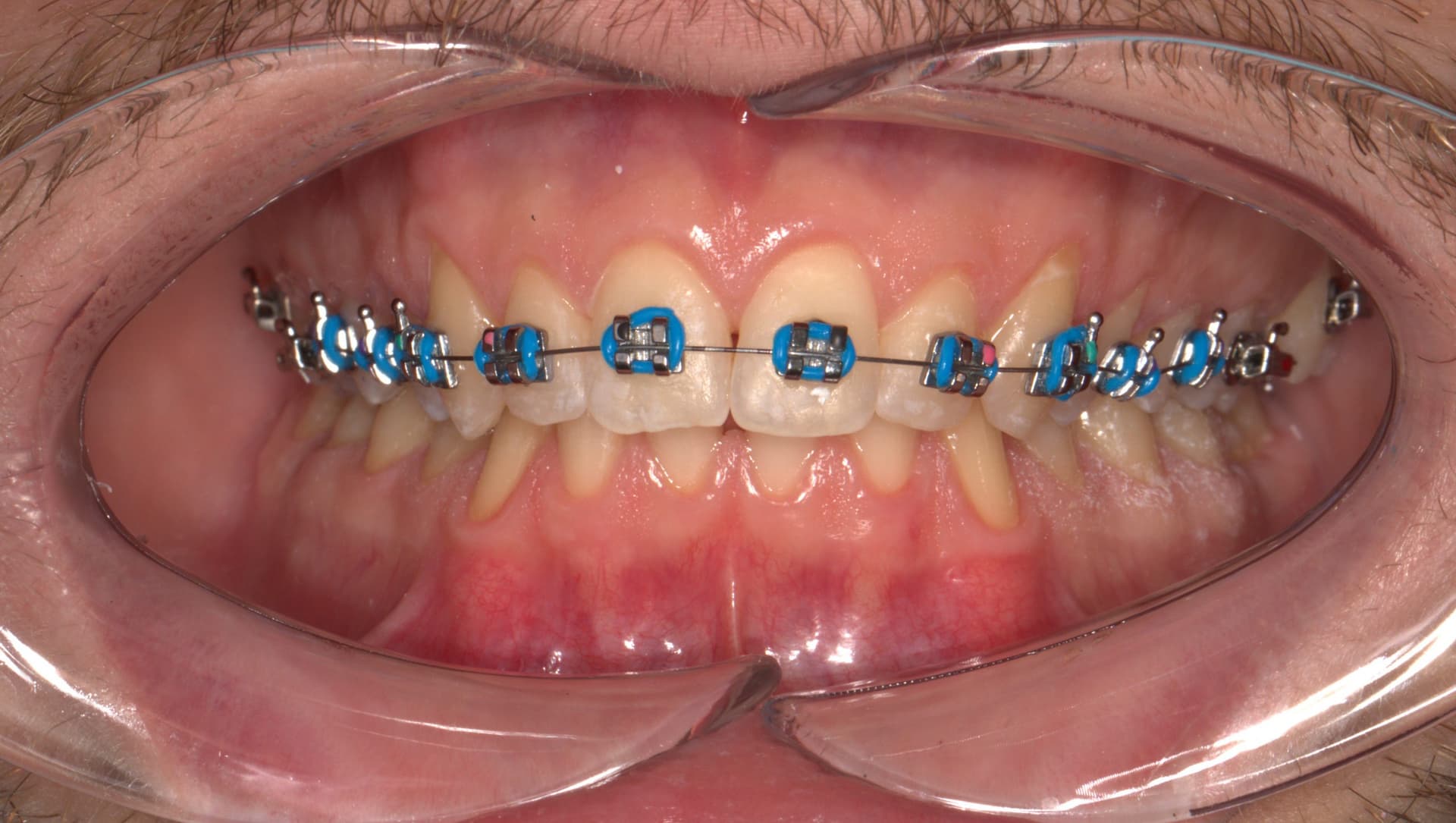 Фиксация брекет системой 