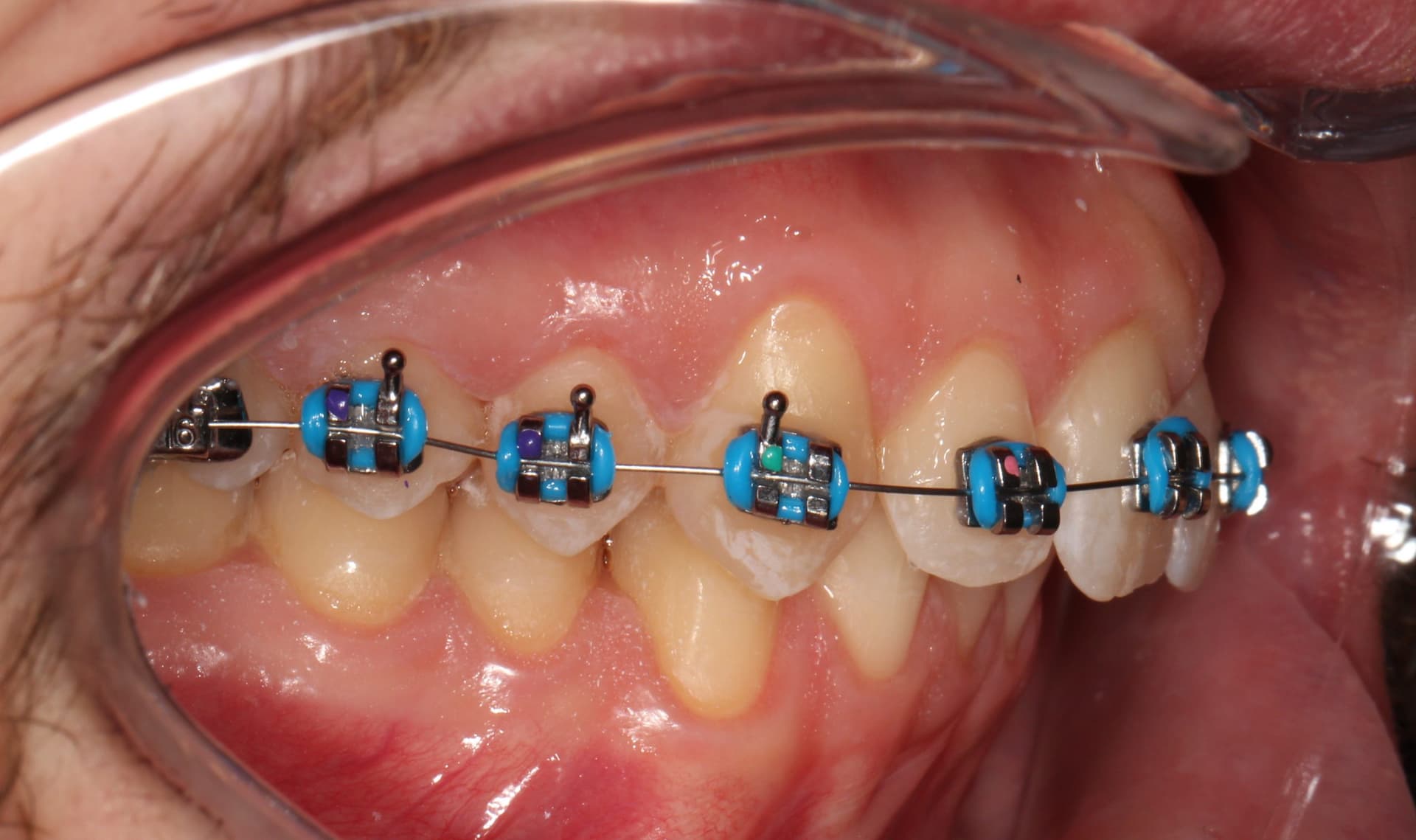 Фиксация брекет системой 