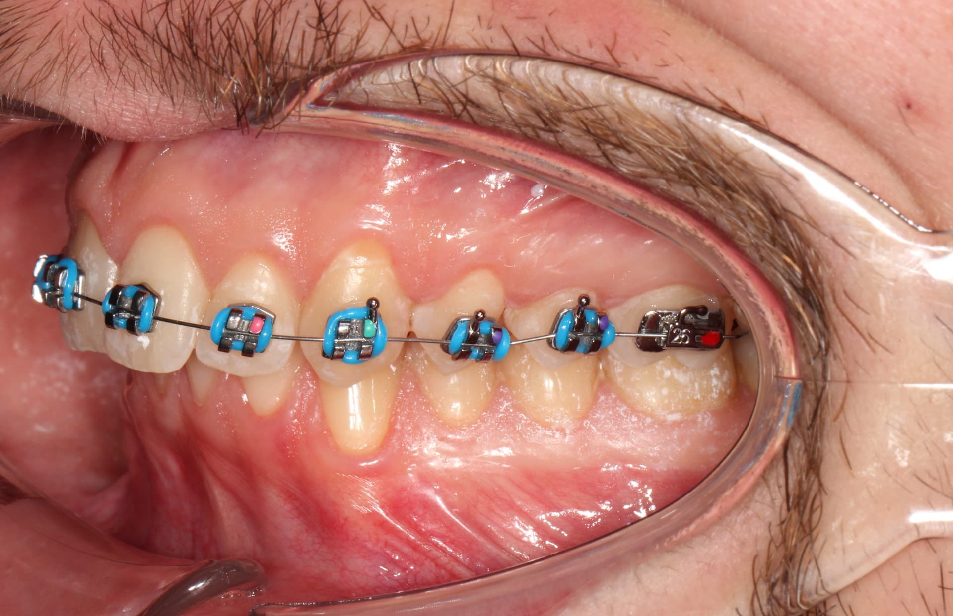 Фиксация брекет системой 