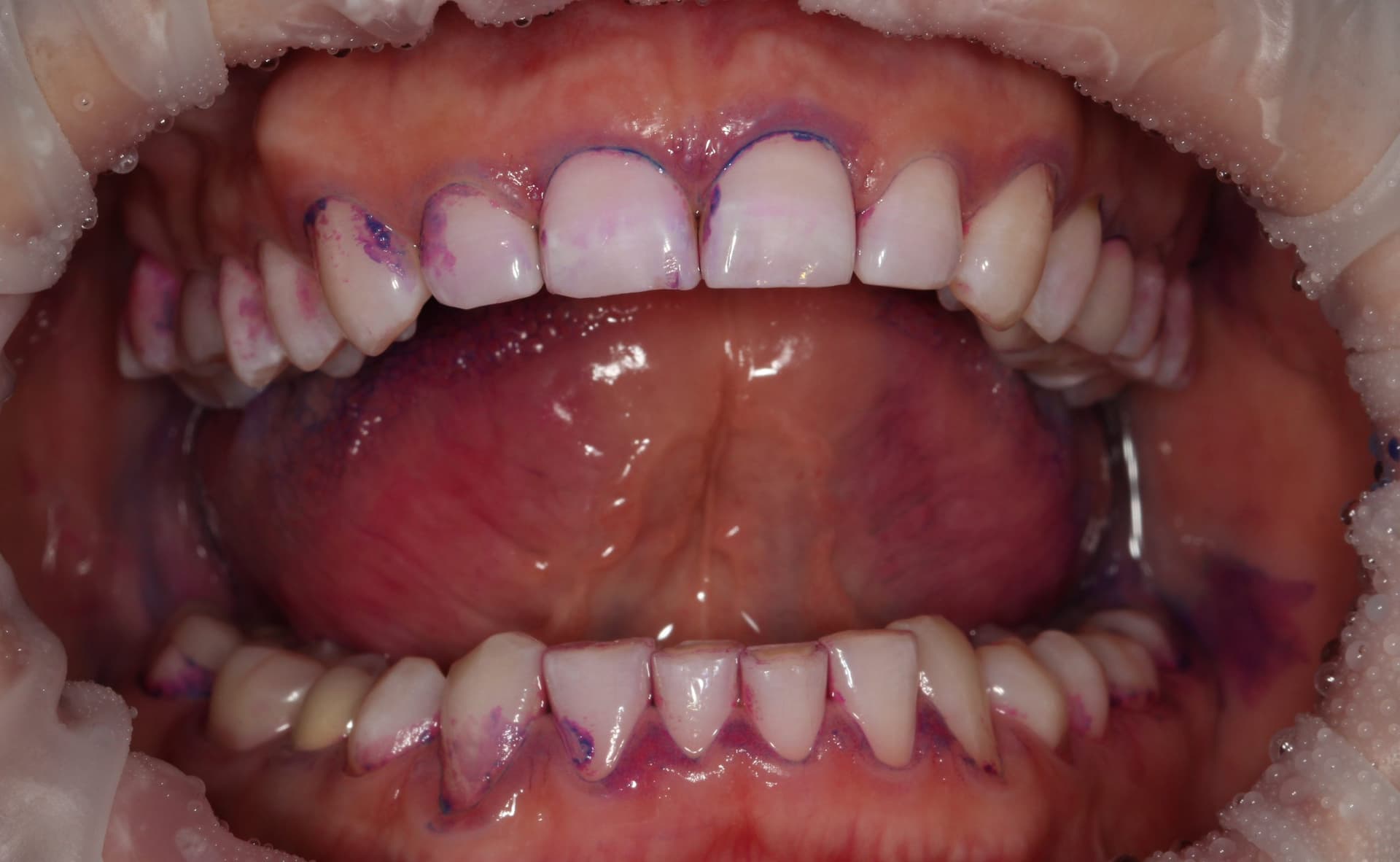 Окрашивание налета