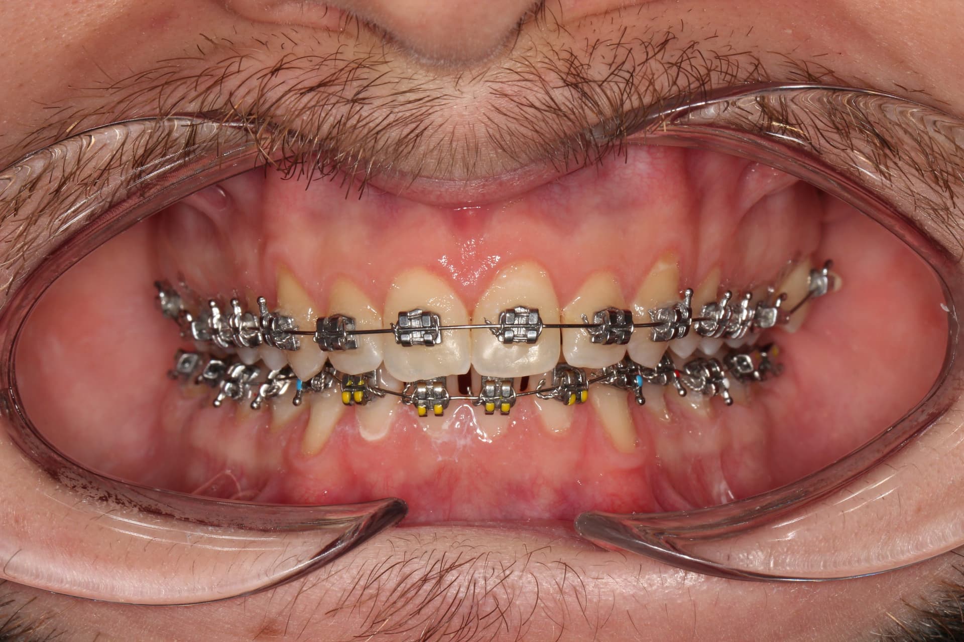 Фиксация брекет системы на нижнюю челюсть 