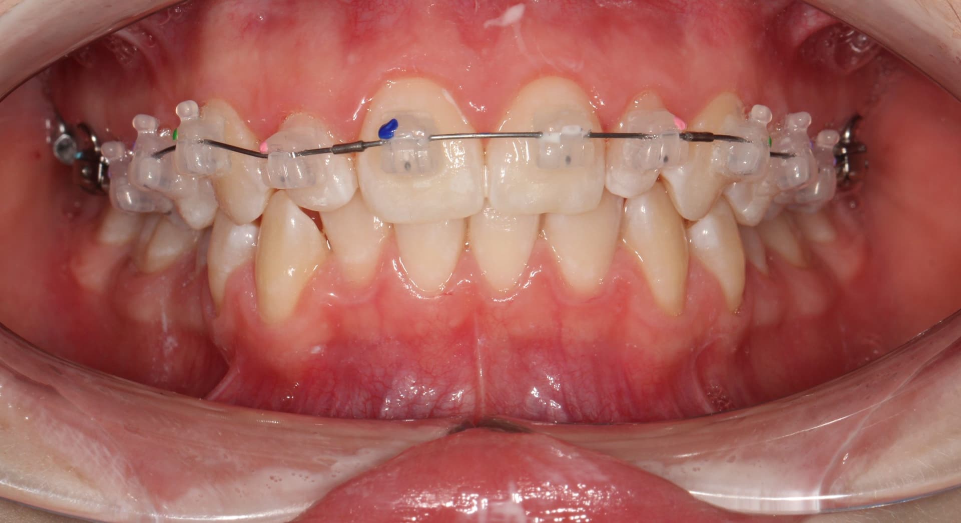 Фиксация брекет системы