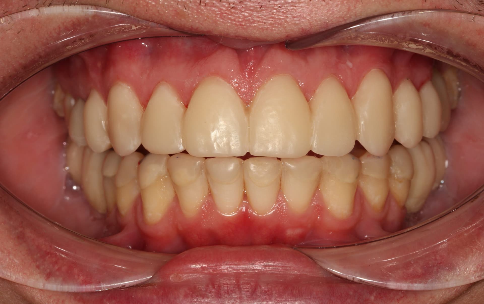 ФИКСАЦИЯ КОНСТРУКЦИИ