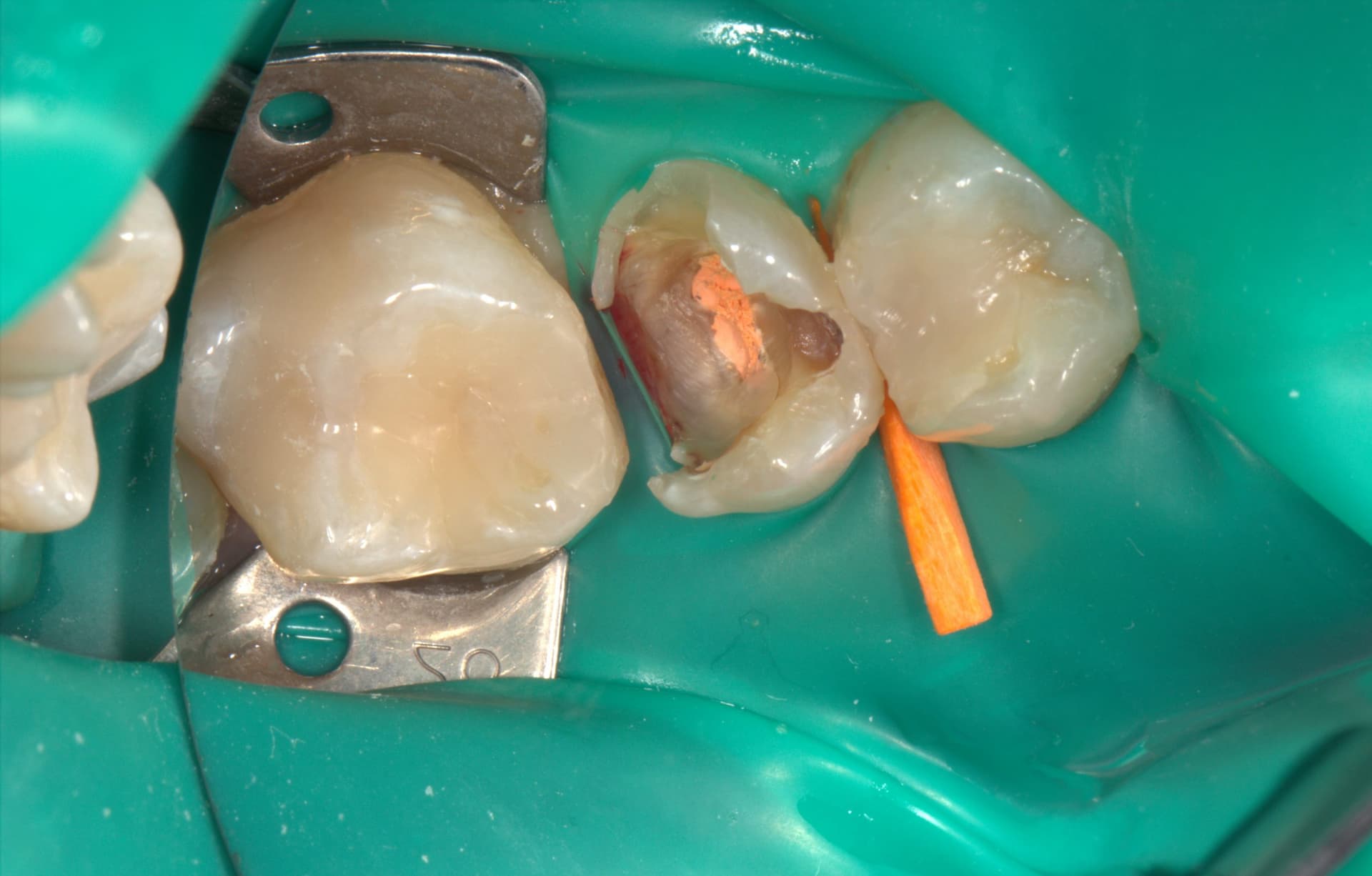 Удаление старой пломбы и запломбировали каналы