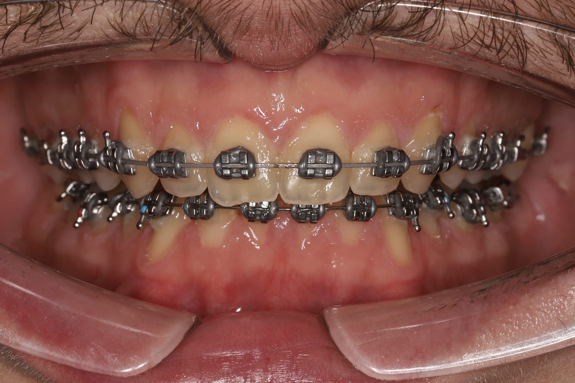 На этапе лечения