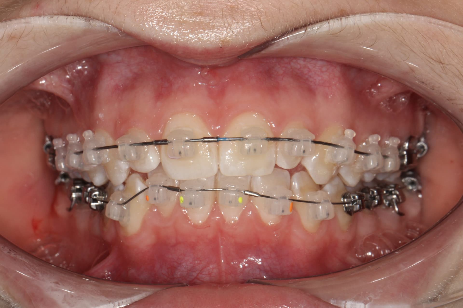 На этапе лечения